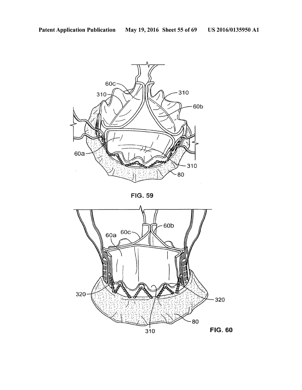 COLLAPSIBLE PROSTHETIC HEART VALVES - diagram, schematic, and image 56