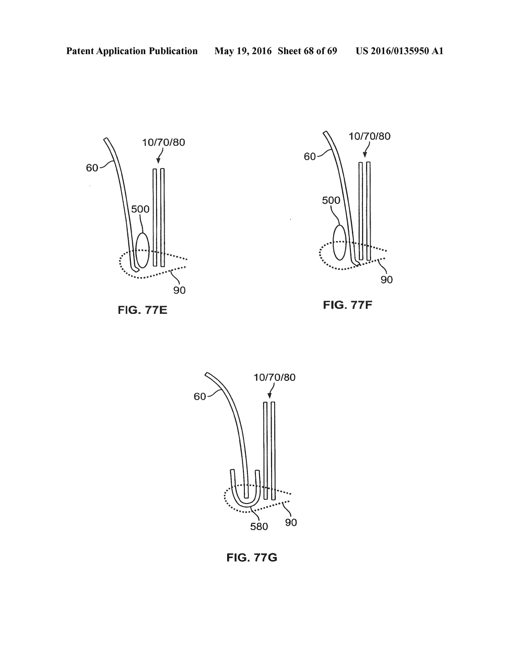 COLLAPSIBLE PROSTHETIC HEART VALVES - diagram, schematic, and image 69