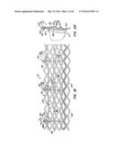 LOW PROFILE HEART VALVE AND DELIVERY SYSTEM diagram and image