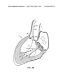 LOW PROFILE HEART VALVE AND DELIVERY SYSTEM diagram and image