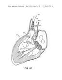 LOW PROFILE HEART VALVE AND DELIVERY SYSTEM diagram and image