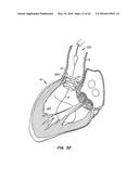 LOW PROFILE HEART VALVE AND DELIVERY SYSTEM diagram and image