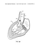 LOW PROFILE HEART VALVE AND DELIVERY SYSTEM diagram and image