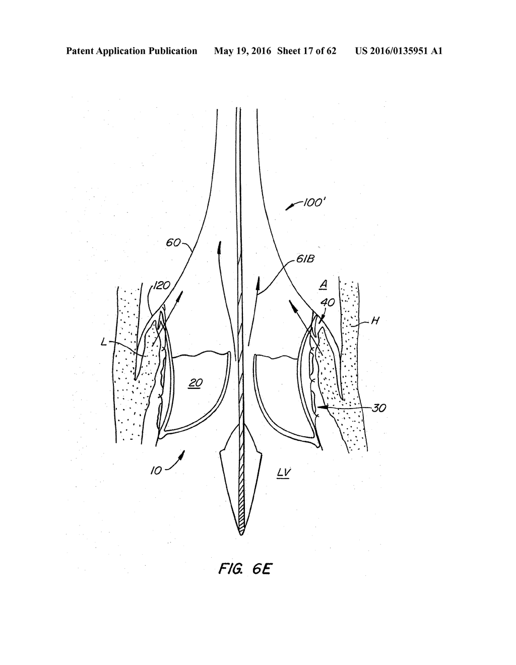 LOW PROFILE HEART VALVE AND DELIVERY SYSTEM - diagram, schematic, and image 18