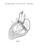 LOW PROFILE HEART VALVE AND DELIVERY SYSTEM diagram and image