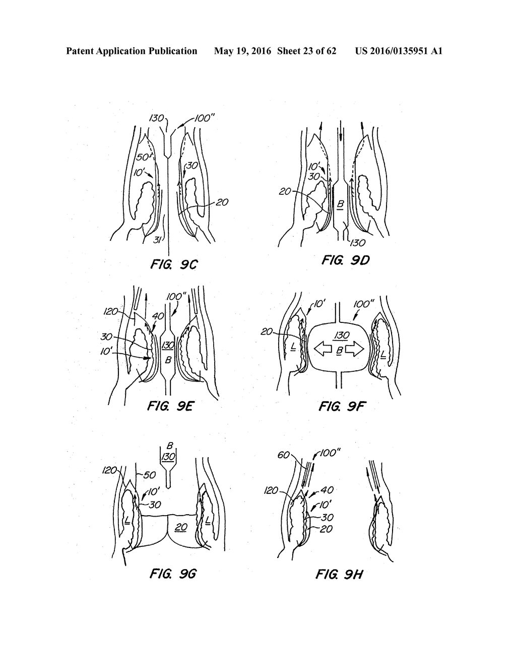 LOW PROFILE HEART VALVE AND DELIVERY SYSTEM - diagram, schematic, and image 24