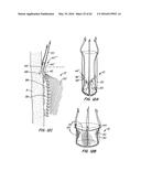 LOW PROFILE HEART VALVE AND DELIVERY SYSTEM diagram and image