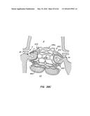 LOW PROFILE HEART VALVE AND DELIVERY SYSTEM diagram and image