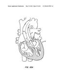 LOW PROFILE HEART VALVE AND DELIVERY SYSTEM diagram and image