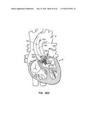 LOW PROFILE HEART VALVE AND DELIVERY SYSTEM diagram and image