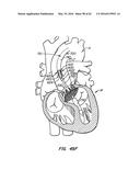 LOW PROFILE HEART VALVE AND DELIVERY SYSTEM diagram and image