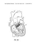 LOW PROFILE HEART VALVE AND DELIVERY SYSTEM diagram and image