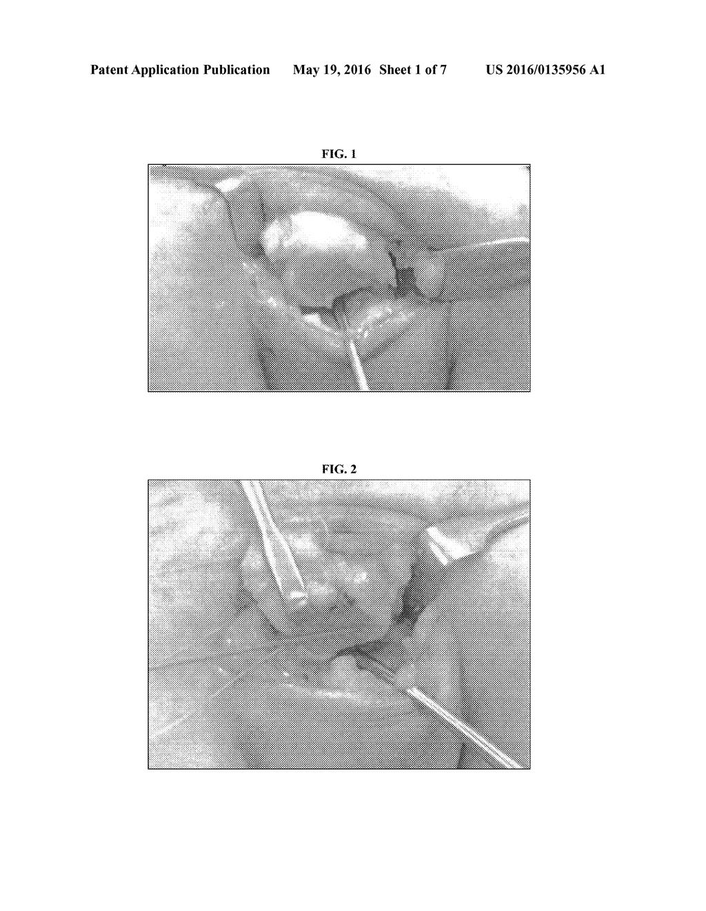 MENISCUS FOR JOINT RECONSTRUCTION - diagram, schematic, and image 02