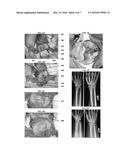 MENISCUS FOR JOINT RECONSTRUCTION diagram and image