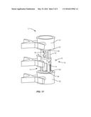 EXPANDABLE SPINAL IMPLANT SYSTEM AND METHOD diagram and image