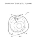 ATTACHMENT SYSTEM FOR PROSTHETIC DEVICE diagram and image