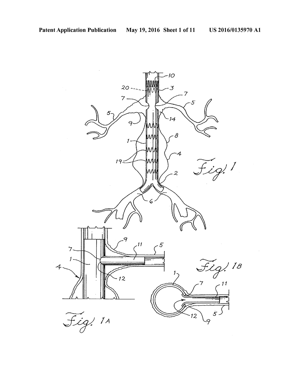 STENT WITH A CRUSH-RESISTANT ZONE - diagram, schematic, and image 02