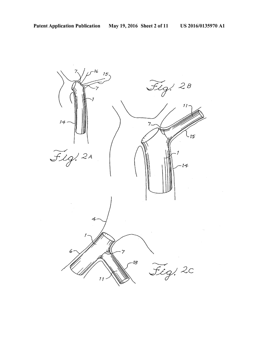 STENT WITH A CRUSH-RESISTANT ZONE - diagram, schematic, and image 03