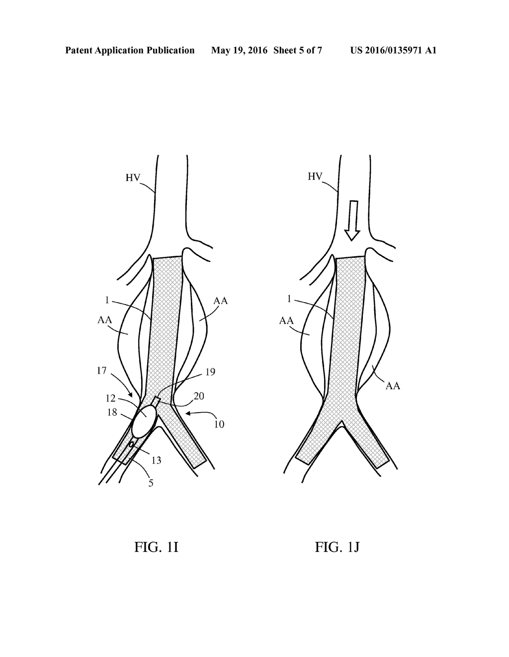 TREATING ENDOLEAKAGES IN AORTIC ANEURYSM REPAIRS - diagram, schematic, and image 06