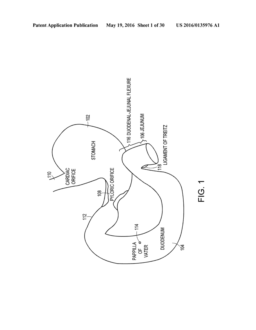 Methods Of Treatment Using A Bariatric Sleeve - diagram, schematic, and image 02