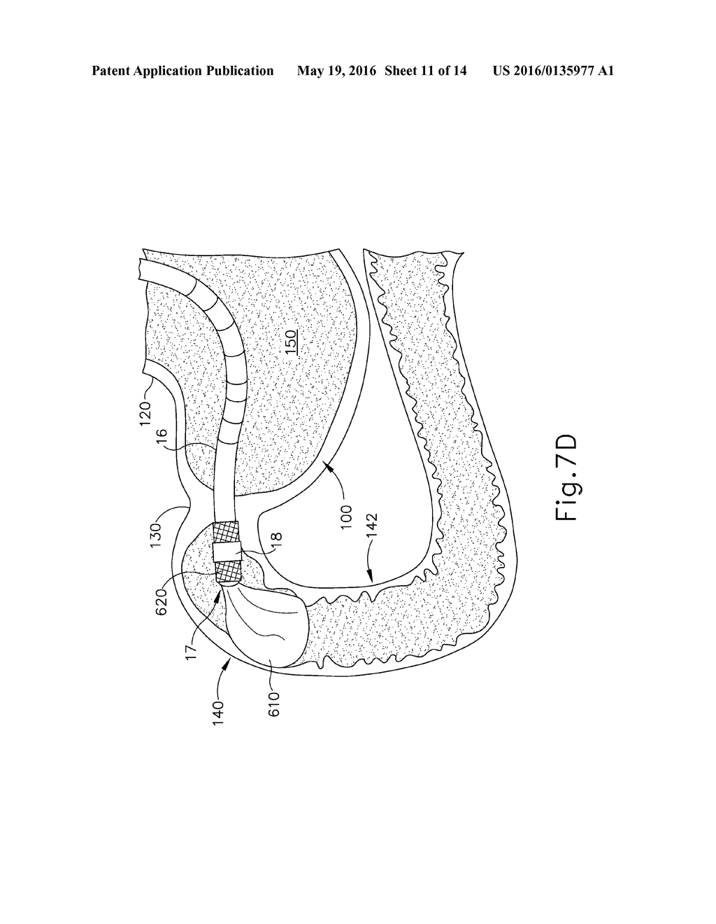 CONFORMING ANCHOR FOR DUODENAL BARRIER - diagram, schematic, and image 12