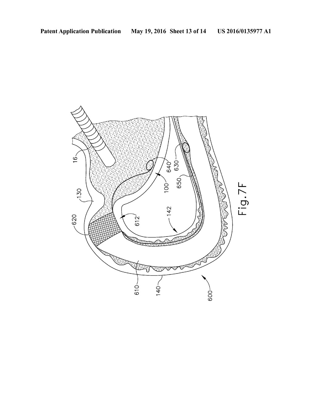 CONFORMING ANCHOR FOR DUODENAL BARRIER - diagram, schematic, and image 14
