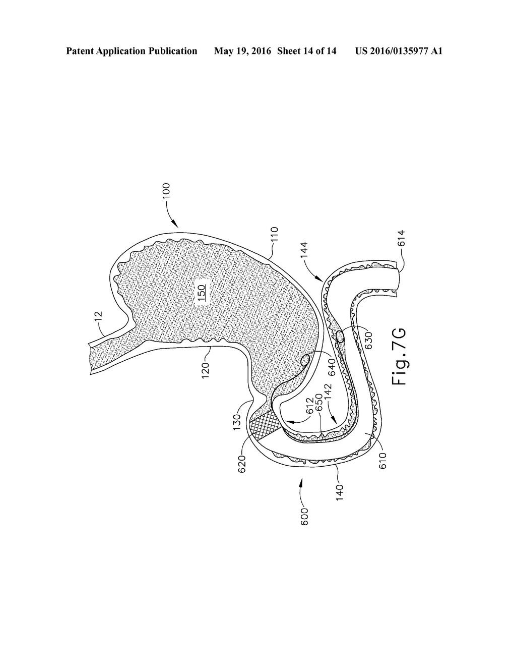CONFORMING ANCHOR FOR DUODENAL BARRIER - diagram, schematic, and image 15