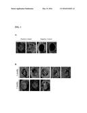 SOMATIC STEM CELLS FOR TREATING BONE DEFECTS diagram and image