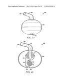 OSCILLATING POSITIVE EXPIRATORY PRESSURE DEVICE diagram and image