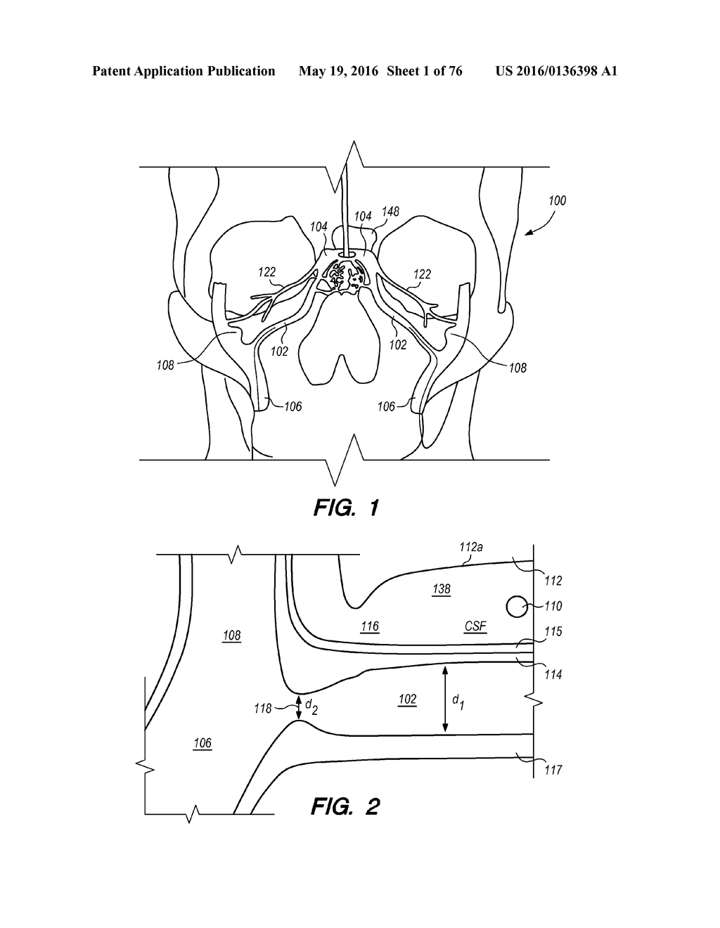 METHODS AND SYSTEMS FOR TREATING HYDROCEPHALUS - diagram, schematic, and image 02