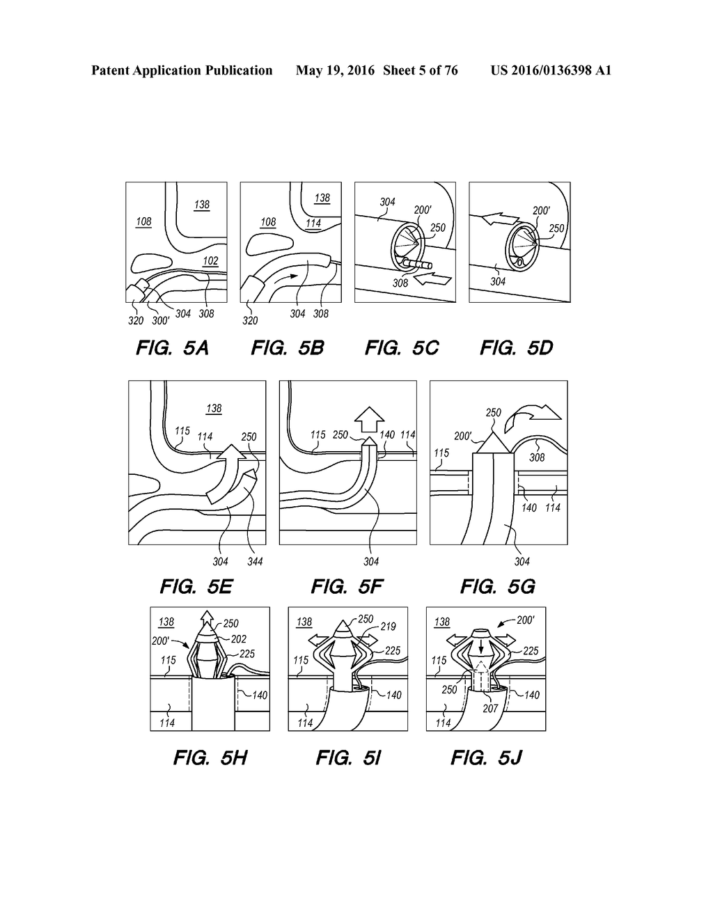 METHODS AND SYSTEMS FOR TREATING HYDROCEPHALUS - diagram, schematic, and image 06