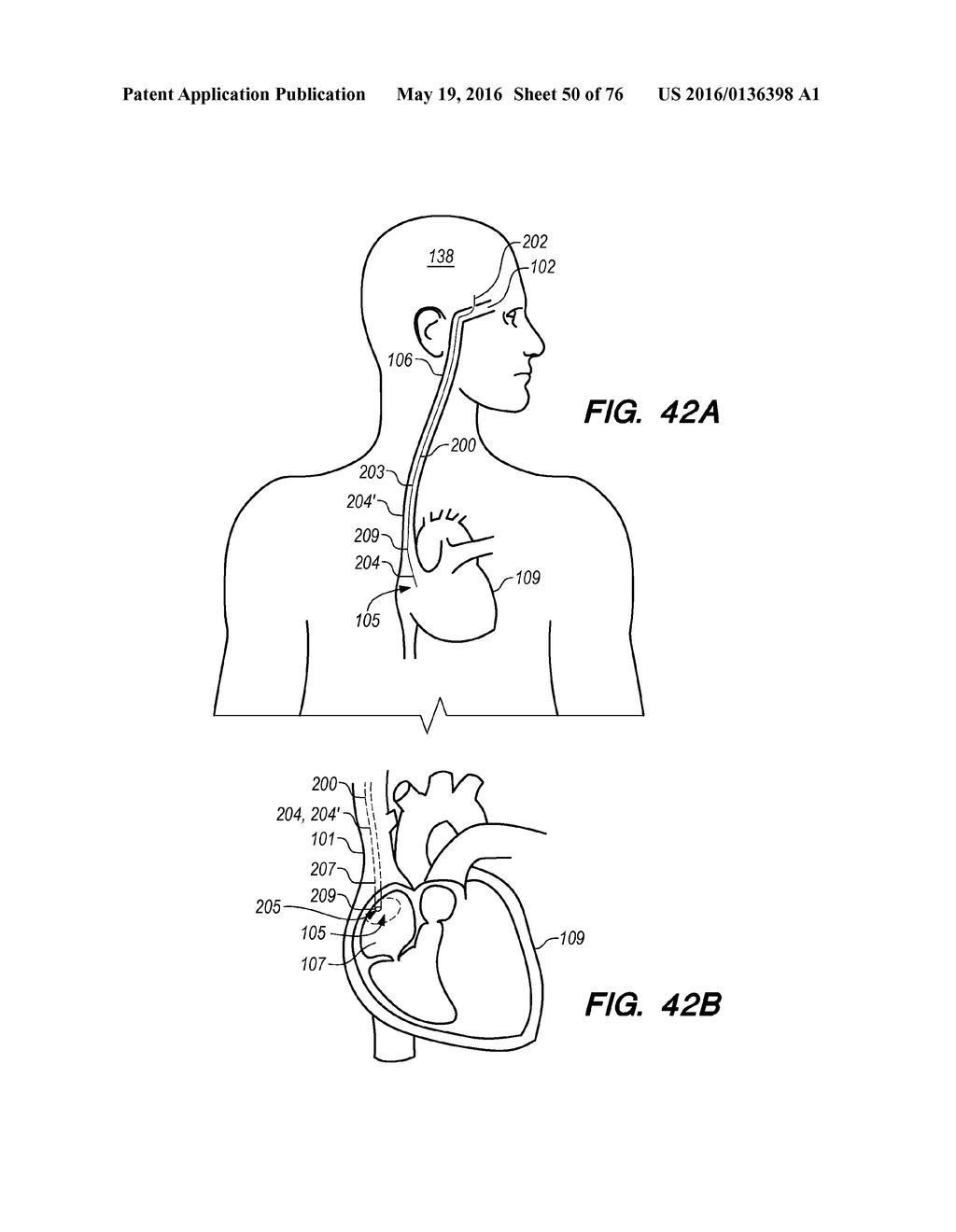 METHODS AND SYSTEMS FOR TREATING HYDROCEPHALUS - diagram, schematic, and image 51