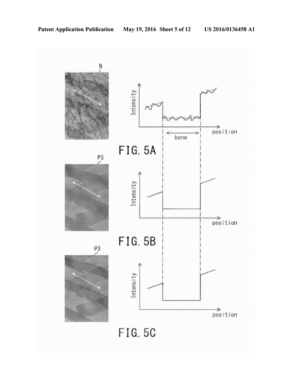 APPARATUS, METHOD, AND PROGRAM FOR PROCESSING MEDICAL IMAGE, AND     RADIOTHERAPY APPARATUS - diagram, schematic, and image 06