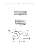 BIODEGRADABLE WIRE FOR MEDICAL DEVICES diagram and image