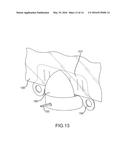 Screen vibration for reducing speckle diagram and image