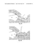 Middle Ear Transducer with Biocompatible Implantable Adhesive Pad diagram and image