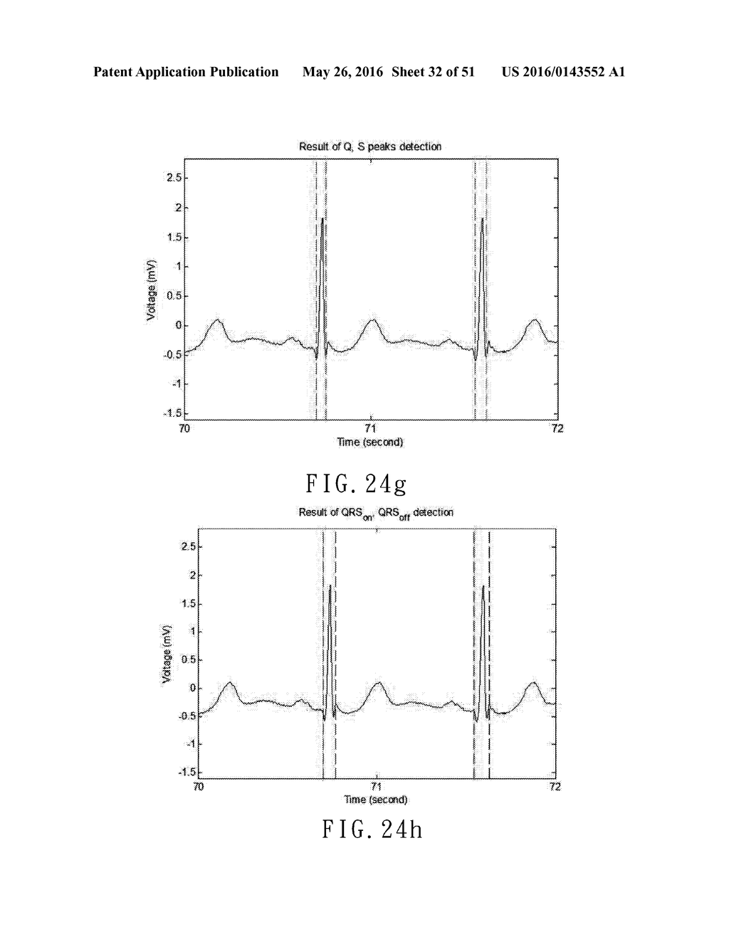 ELECTROCARDIOGRAPHY SIGNAL EXTRACTION METHOD - diagram, schematic, and image 33