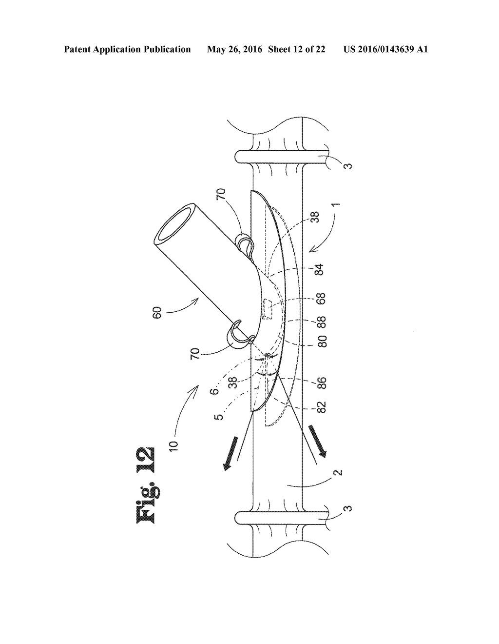 VASCULAR ANASTOMOSIS DEVICE AND METHOD - diagram, schematic, and image 13