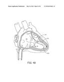 DELIVERY SYSTEM ASSEMBLIES FOR IMPLANTABLE MEDICAL DEVICES diagram and image