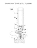 PEDICLE SCREW SYSTEM AND SPINAL STABILIZATION SYSTEM diagram and image