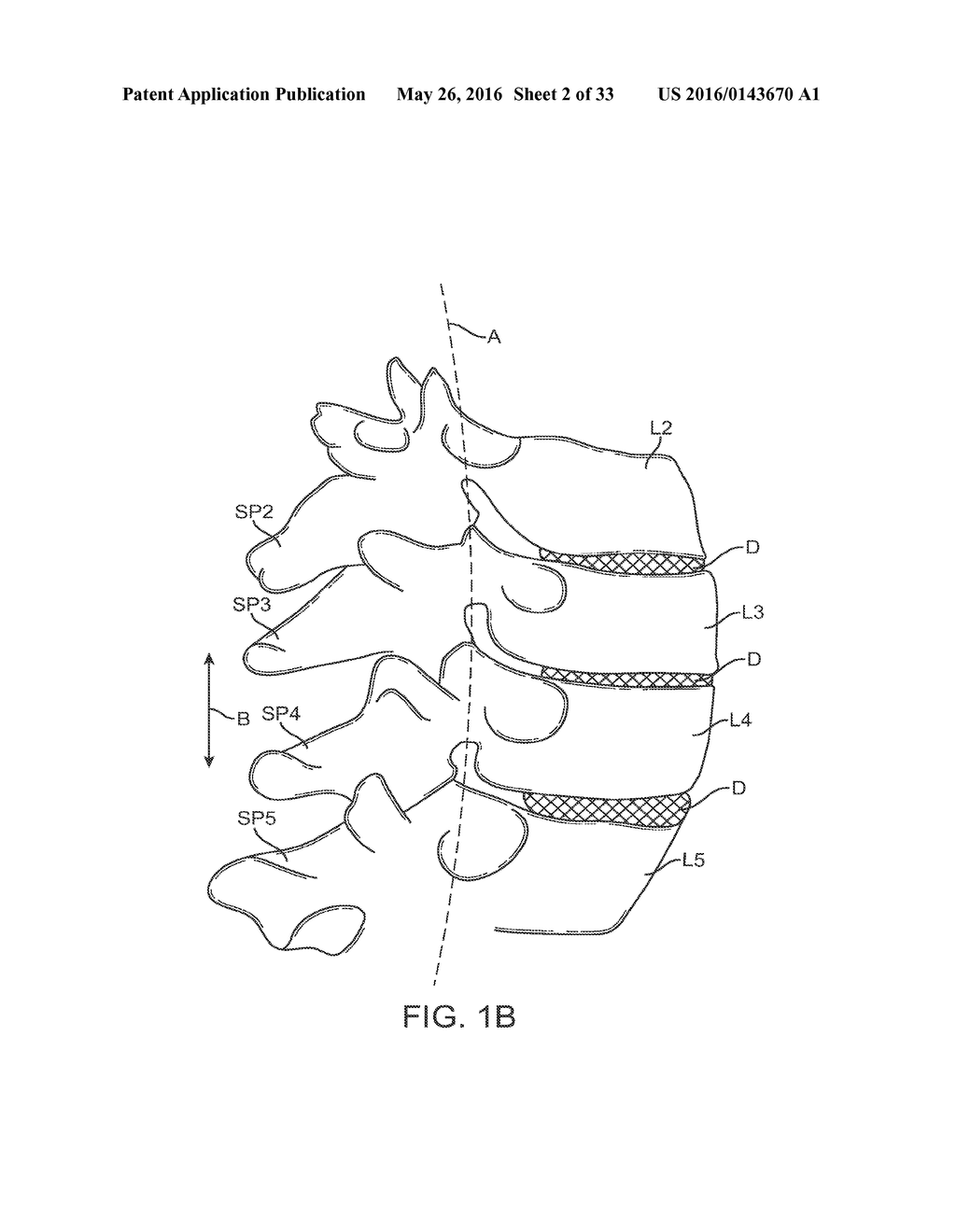 METHODS AND APPARATUS FOR COUPLING A PROSTHESIS TO A SPINAL SEGMENT - diagram, schematic, and image 03