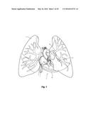 METHODS AND APPARATUS FOR TREATING PULMONARY EMBOLISM diagram and image