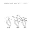 TRANSCATHETER MITRAL VALVE diagram and image