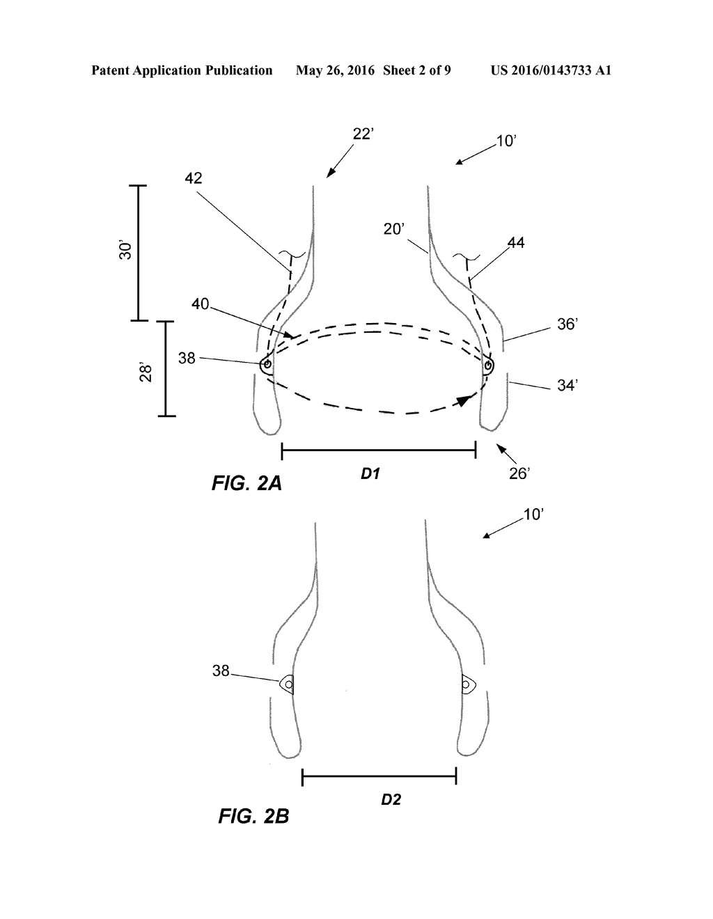 REPLACEMENT HEART VALVE AND METHOD - diagram, schematic, and image 03