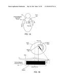 ADJUSTABLE IMPLANT SYSTEM diagram and image