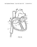 ADJUSTABLE IMPLANT SYSTEM diagram and image