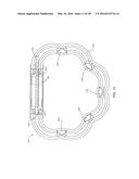 ADJUSTABLE IMPLANT SYSTEM diagram and image