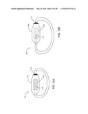 ADJUSTABLE IMPLANT SYSTEM diagram and image