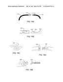 ADJUSTABLE IMPLANT SYSTEM diagram and image