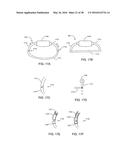 ADJUSTABLE IMPLANT SYSTEM diagram and image